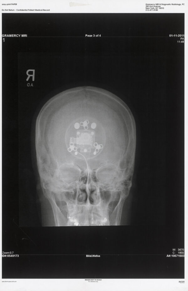 An x-ray of the back of somebody's head with a foreign inside