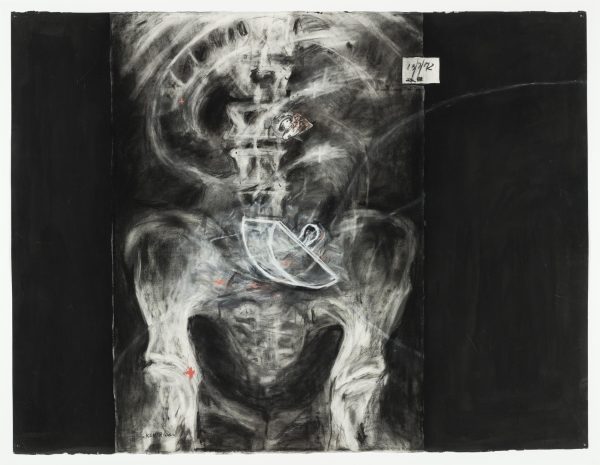 Drawing of an x-ray of a person's lower torso